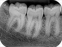 Radiografias Periapicais 