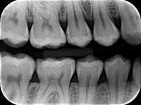 Radiografias Interproximais